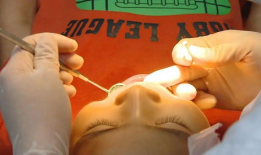 拔牙视频全过程